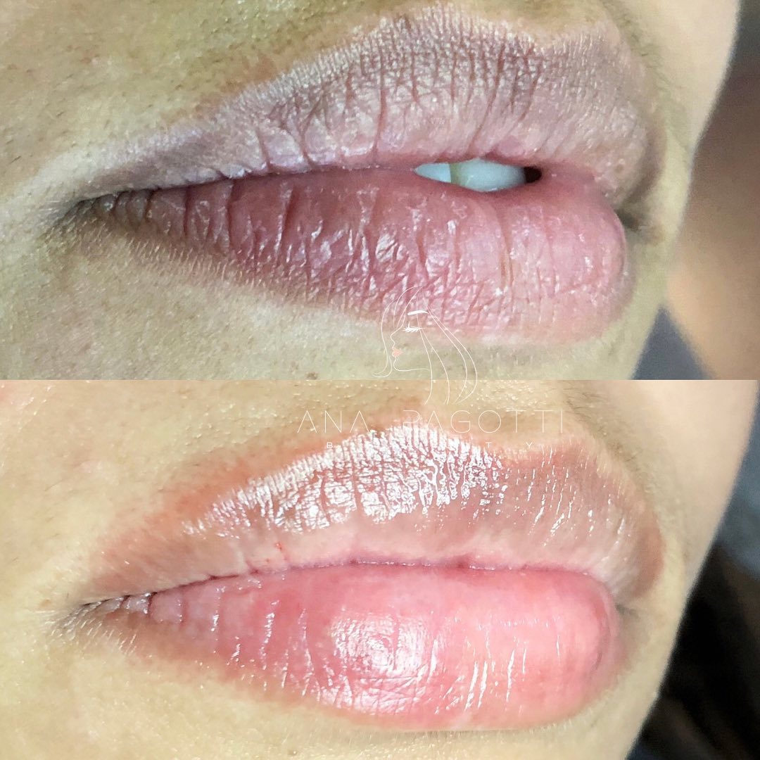 Lábios com hidragloss