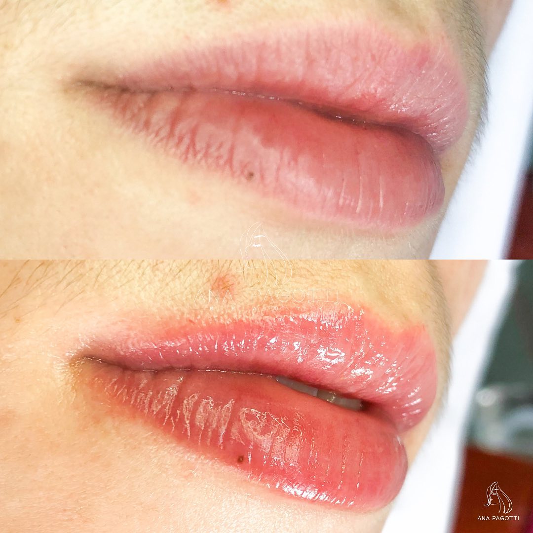 Lábios com hidragloss